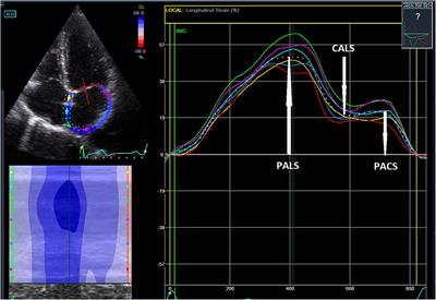 Left Heart Dysfunction in Acromegaly Revealed by Novel Echocardiographic Methods